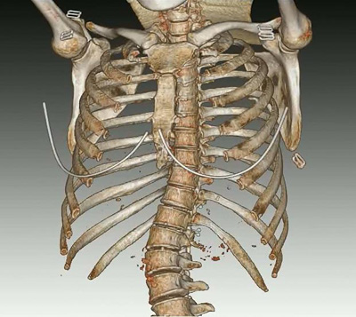 博为医学影像三维重建推动张家口市第二医院发
