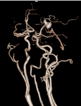 血管筛查(CTA)三维分析1.png